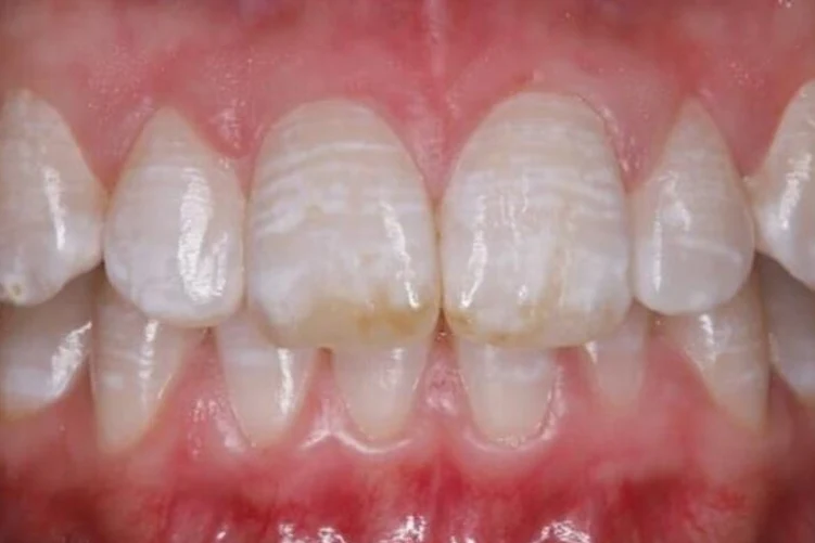 Флюороз зубов — до лечения